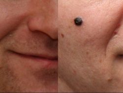 Tanning bed tingkatkan risiko melanoma 3x lipat